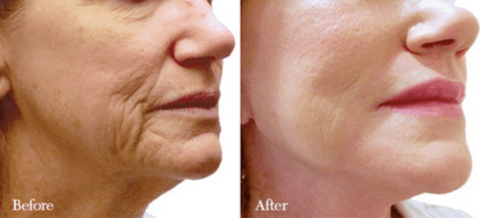 before and after photos of a woman who had a facelift