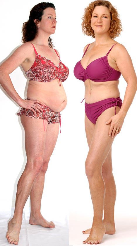 patient before and after tummy tuck