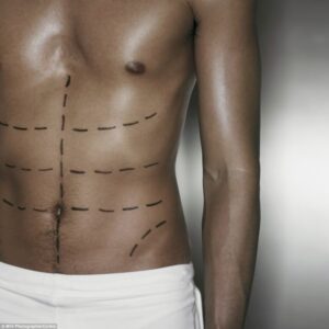 male body marked up for cosmetic surgery