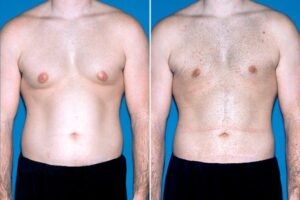 before and after photos of a male breast reduction