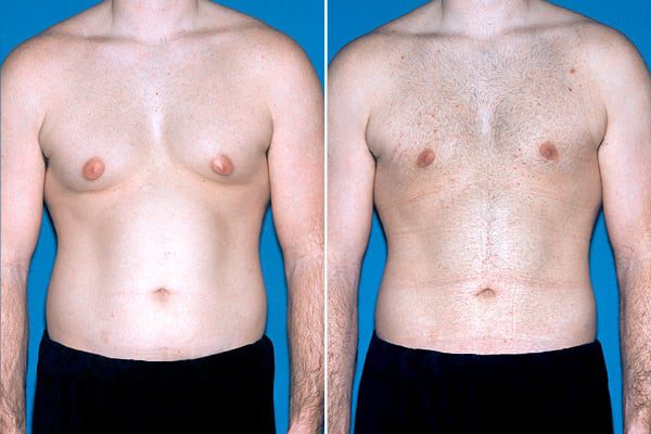 man before and after male breast reduction surgery