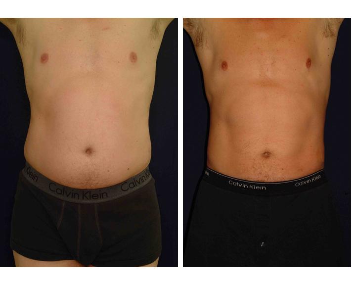before and after photos of male liposuction patient
