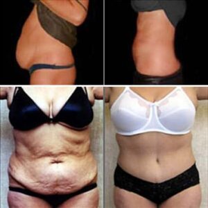 tummy tuck before and after photos